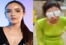 Jasmine Bhasin Suffers Eye Damage from Contact Lenses